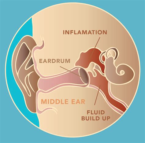 What draws out an ear infection?