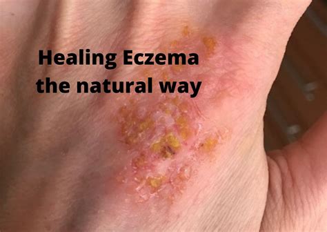 What eczema will not heal?