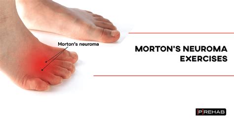 What exercises can you do for Morton's toe?