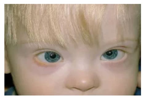 What eye shape is Down syndrome?