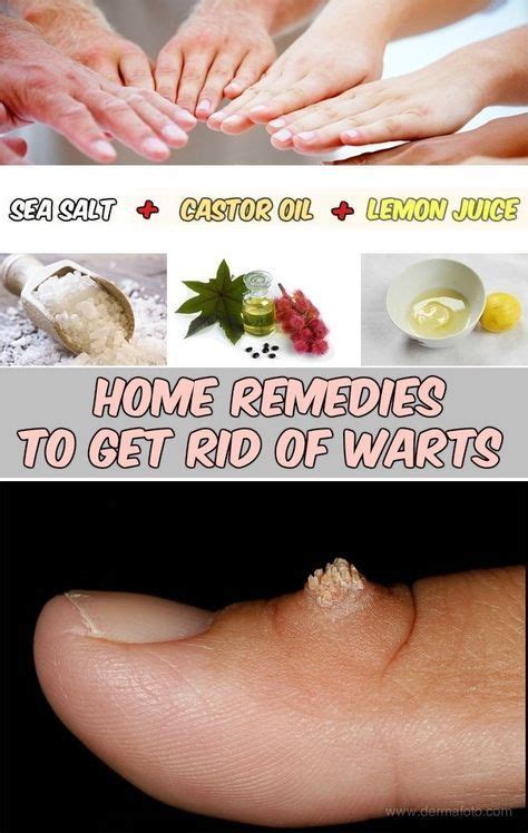 What foods stop warts?