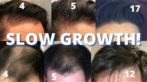 What hair grows slowest?