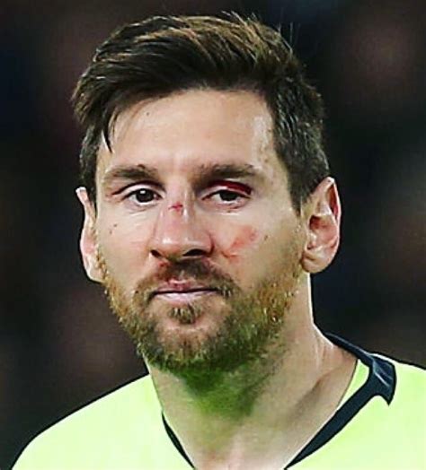 What happened to Messi eye?