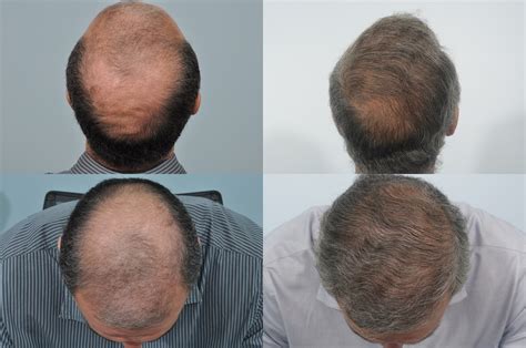 What happens 10 years after hair transplant?