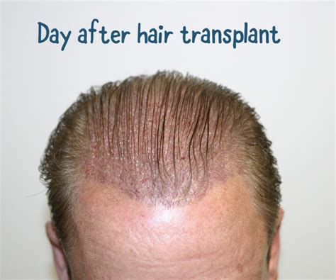 What happens 20 years after hair transplant?