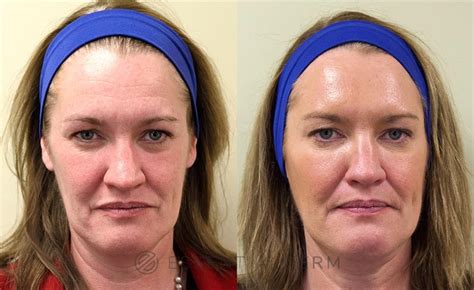 What happens after 30 years of Botox?