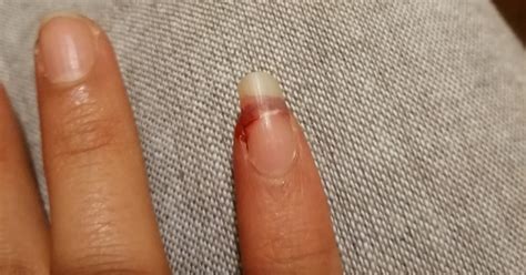 What happens if I hit my nail and it hurts?