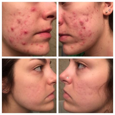 What happens if I miss 3 days of Accutane?