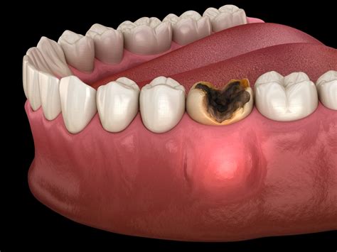 What happens if I pull my own infected tooth?