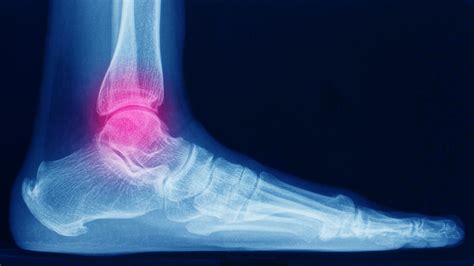 What happens if a foot injury goes untreated?