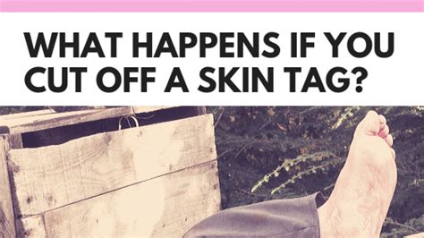 What happens if a skin tag is ripped off?
