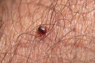 What happens if a tick's head is stuck in your skin NHS?