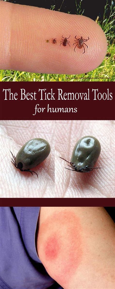 What happens if a tick is never removed?