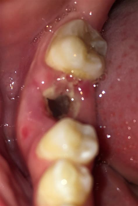 What happens if a tooth extraction is not healing after 2 weeks?