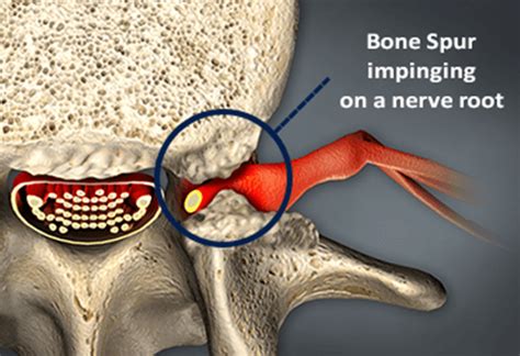 What happens if bone spurs are left untreated?