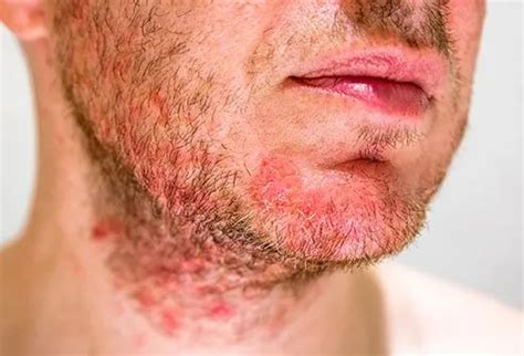 What happens if folliculitis goes untreated?