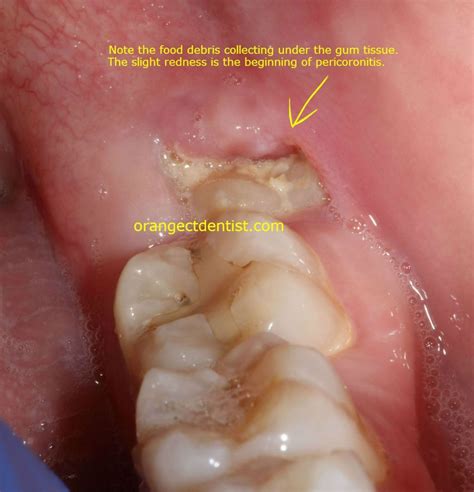 What happens if gum hasn't healed after extraction?