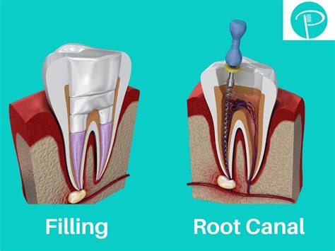 What happens if my dentist doesn't finish my root canal?