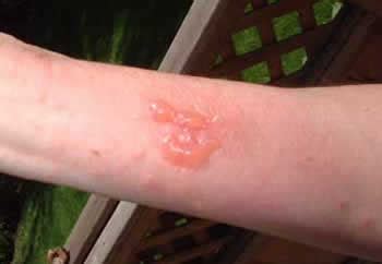 What happens if my poison ivy blister pops?