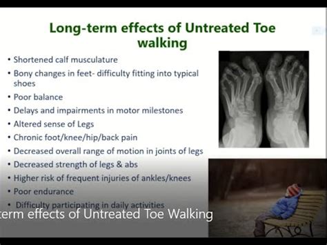 What happens if toe walking goes untreated?