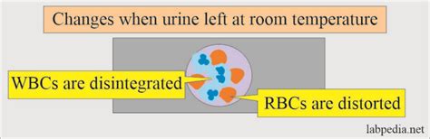 What happens if urine is left at room temperature?