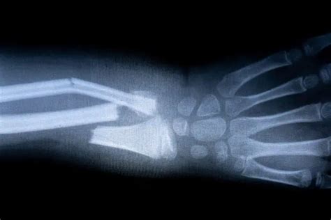 What happens if you break a bone in space?