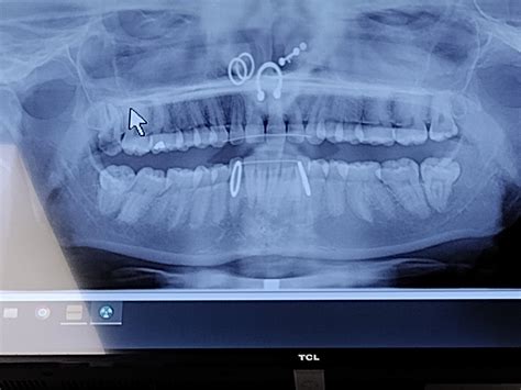 What happens if you can't take out a piercing for an xray?