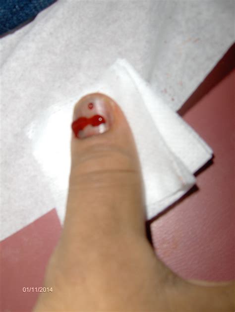 What happens if you don't drain blood under nail?