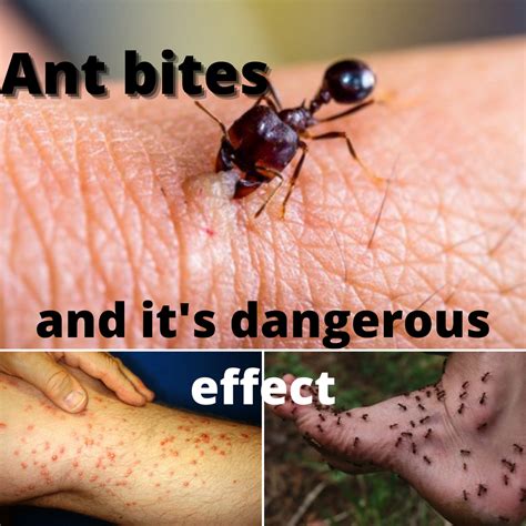 What happens if you don't pop an ant bite?