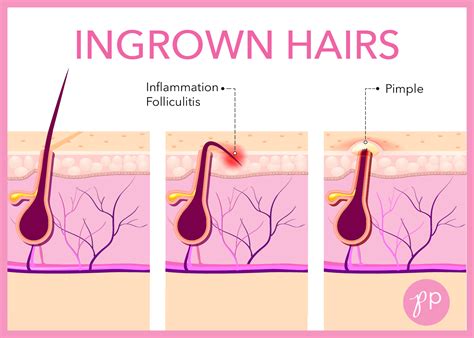 What happens if you don't pop an ingrown hair?