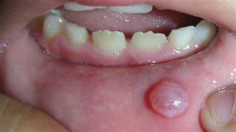 What happens if you don't remove a mucocele?