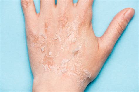 What happens if you don't rub off dead skin?