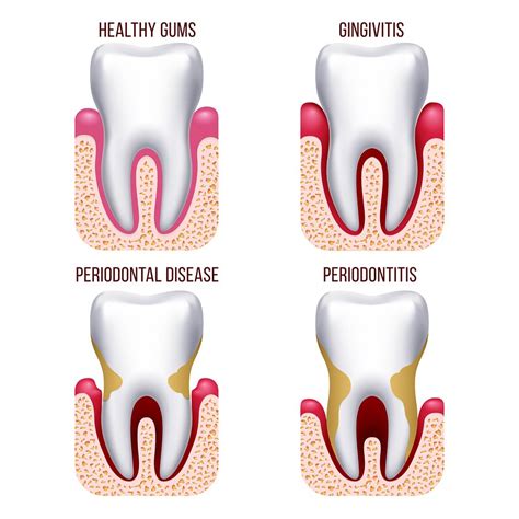 What happens if you don't treat periodontitis?