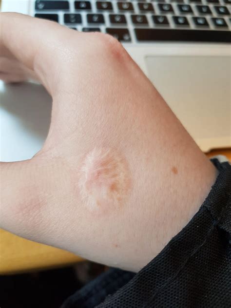 What happens if you get hot glue on your skin?