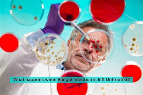 What happens if you have a fungal infection for too long?