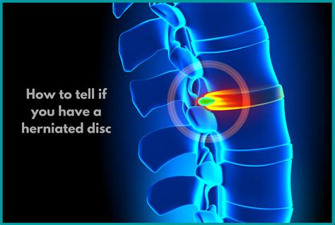 What happens if you ignore a herniated disc?