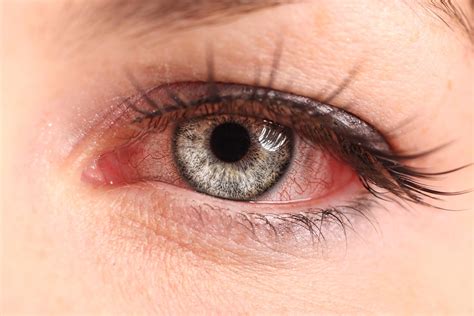 What happens if you ignore pink eye?