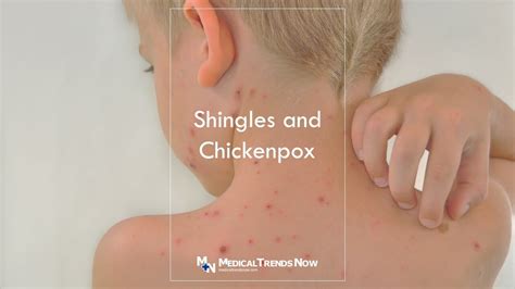 What happens if you never had chickenpox?