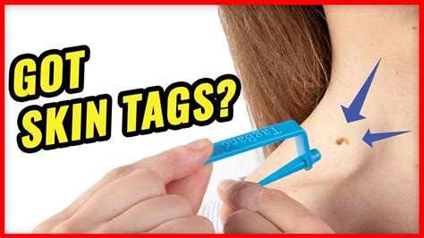 What happens if you pick off skin tags?