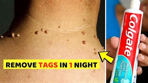 What happens if you remove your own skin tags?