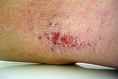 What happens if you scratch off eczema?