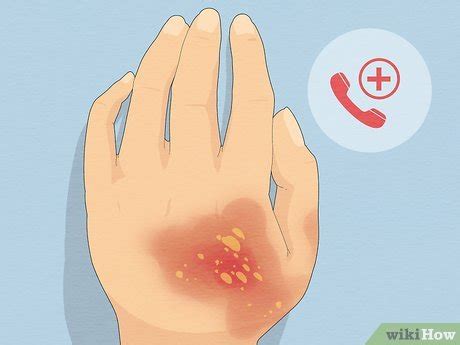 What happens if you spill hot water on your skin?