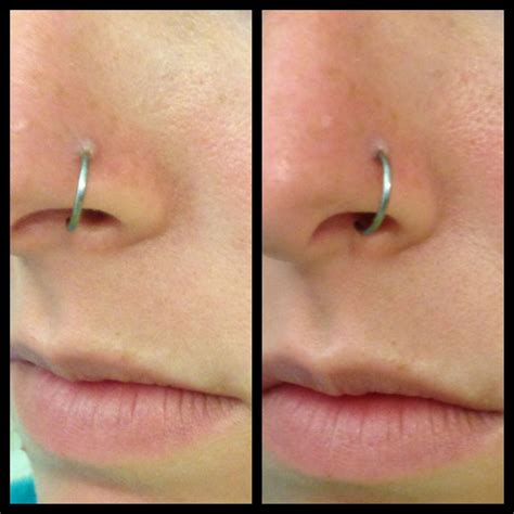 What happens if your nose piercing wont heal after 2 years?