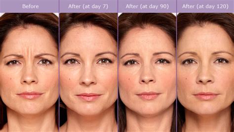 What happens to Botox after 3 months?