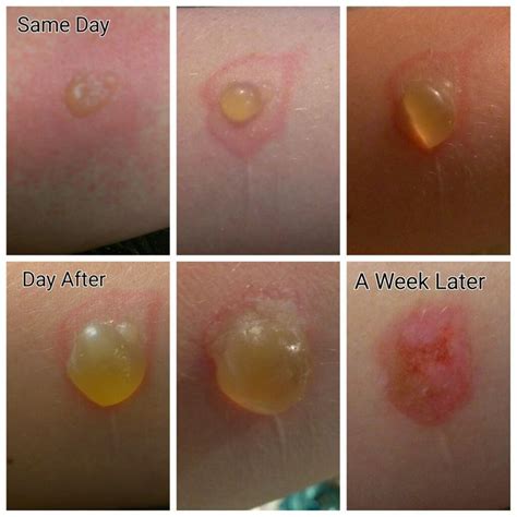 What happens to an untreated second-degree burn?