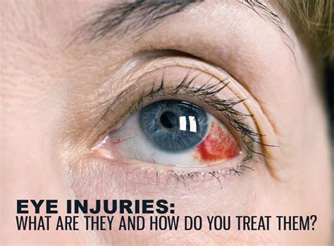What happens to eyes after trauma?