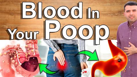 What happens when you fart and blood comes out?