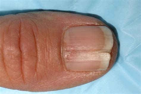 What happens when you hit your fingernail really hard?