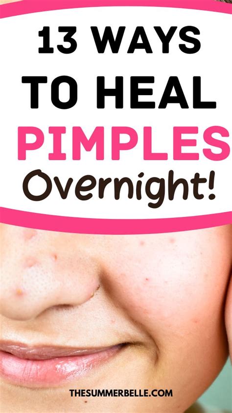 What heals a pimple overnight?