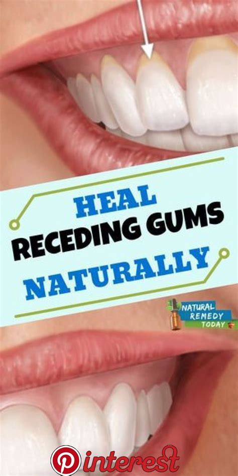 What heals gums the fastest?